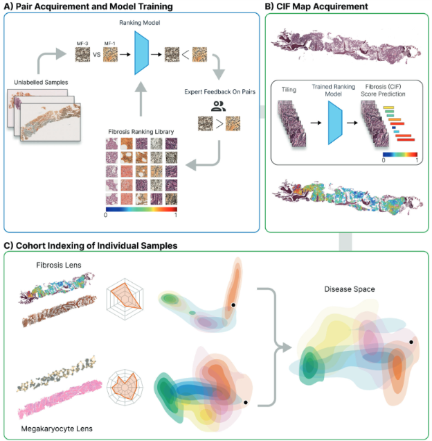 Caption: Outline of the computational steps necessary for bone marrow trephine fibrosis (reticulin) detection, quantification, and visualization. A) First, images are manually selected which indicate fibrosis and labeled with a fibrosis grade according to an expert. These tiles are used to train a machine learning model. Human-in-loop judges the model’s response. B) Second, trephine tissue samples new to the model are graded using the continuous indexing of fibrosis (CIF) score. A color map of fibrosis is superimposed upon the reticulin-stained image. C) Finally, by analyzing patterns in fibrosis scores, the researchers created a two-dimensional map that shows how different MPN subtypes relate to each other. This map allows researchers to compare individual patient’s bone marrow to a library of others — and when combined with features from other cells like